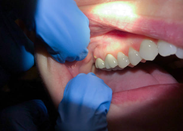Best Emergency Treatment for Oral Infections in Fort Lupton, CO